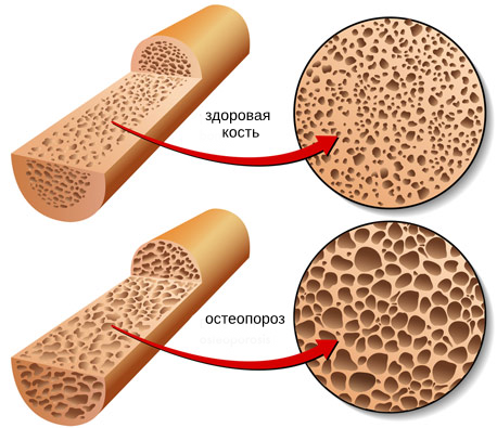 7 важных шагов для предотвращения остеопороза